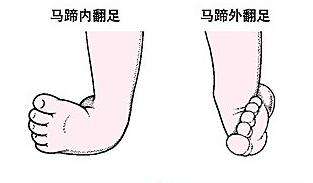 先天性馬蹄內翻足
