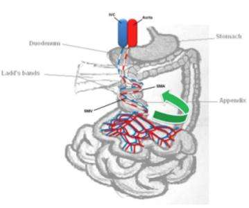 先天性腸旋轉(zhuǎn)不良